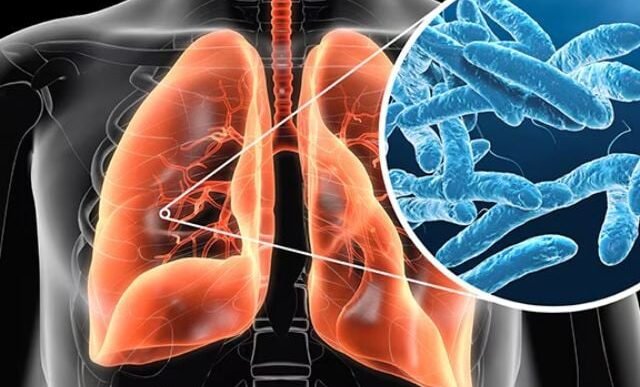 legionnaires disease