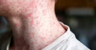 What should you do if you think you have the measles?