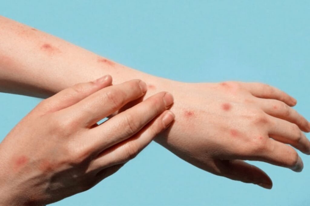 Pharmacist Can Positively Influence Mpox Vaccinations