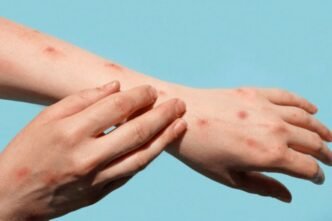 Pharmacist Can Positively Influence Mpox Vaccinations