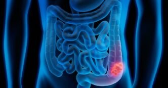Study Reveals Promising Results in Fight Against Colon Cancer